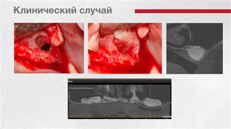 Восстановление после перфорации