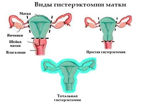 Все о удалении матки с придатками: основные вопросы и ответы