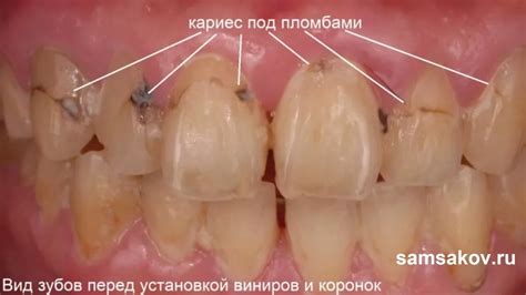 Вторичный кариес: причины, симптомы и лечение