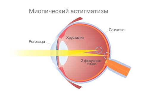 Выводы и перспективы лечения миопического астигматизма