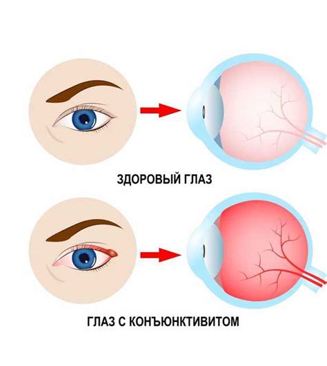 Выводы о проблеме жжения в глазах