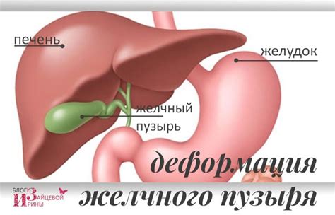 Выводы о расширении желчного пузыря и лечение его последствий