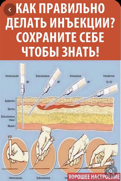 Выразительный сон: значимость высокотехнологичного укола в верхнюю конечность