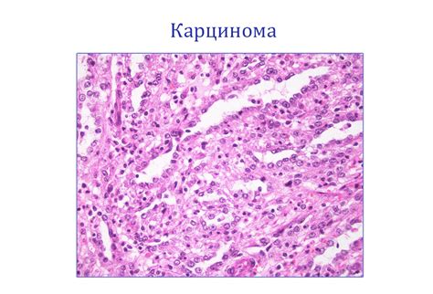 Высокодифференцированная карцинома: симптомы, лечение и прогноз