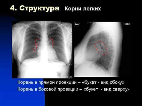 В каких случаях возникают сосудистые корни легких?