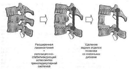 В чем суть сдавления дурального мешка?