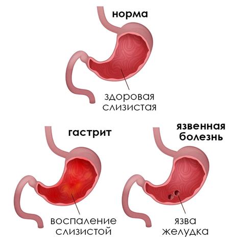 Гастрит и язва желудка