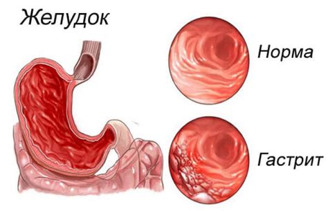 Гастрит с кишечной метаплазией: симптомы и диагностика