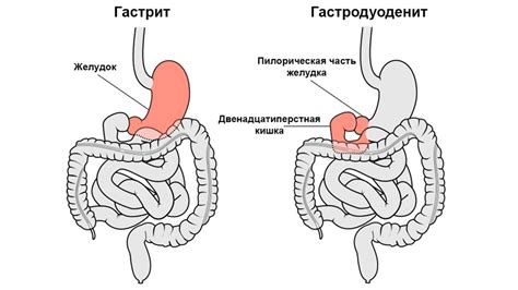 Гастродуоденит: причины и симптомы