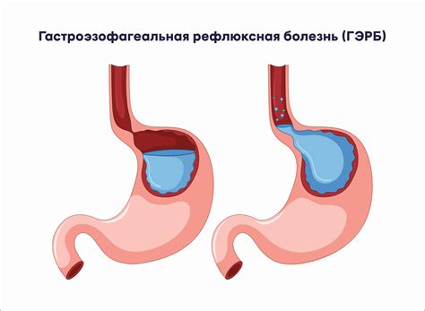 Гастроезофагеальная рефлюксная болезнь