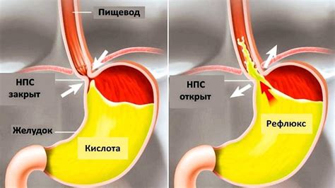 Гастроинтестинальные проблемы: рефлюкс и его связь с налетом