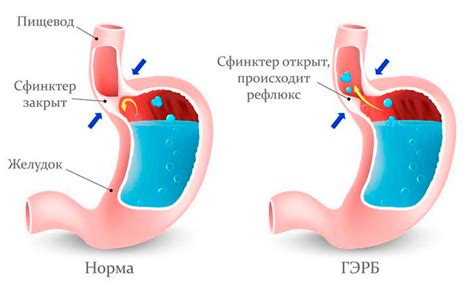 Гастроэзофагеальный рефлюкс: что это такое?