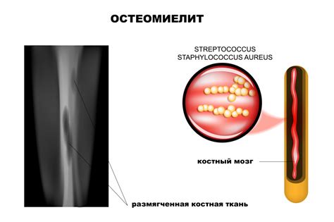 Гематогенный остеомиелит: определение и симптомы