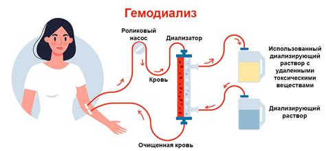 Гемодиализ при усыхании почек