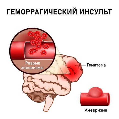 Геморрагический инсульт: характеристики и типы