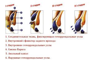 Геморроидальный узел: главные признаки