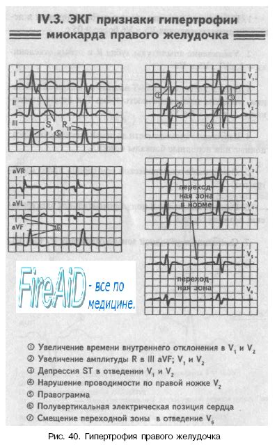 Генерализованная миоклоническая литическая зона (ГМЛЖ) на ЭКГ