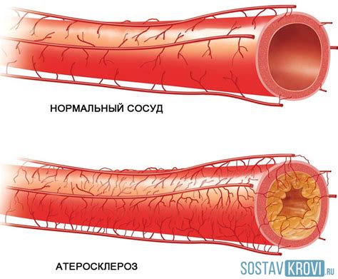 Генетическая предрасположенность и слабые сосуды