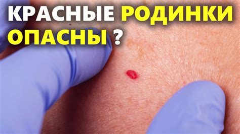 Генетические причины появления новой родинки