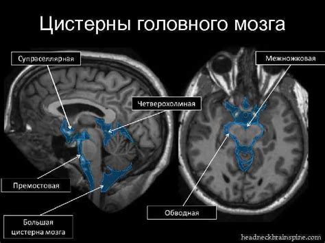 Генетические факторы, влияющие на увеличение цистерны мозга