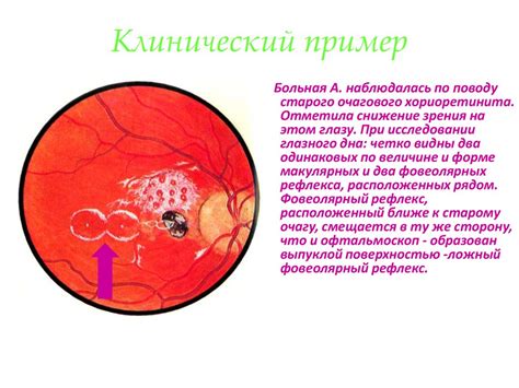 Генетические факторы, вызывающие отсутствие глазного дна