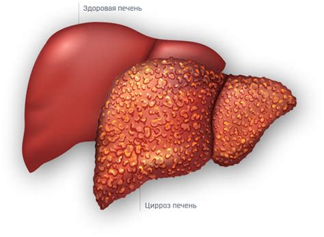 Гепатит и цирроз печени
