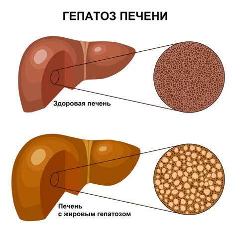 Гепатоз печени: причины, симптомы, примеры