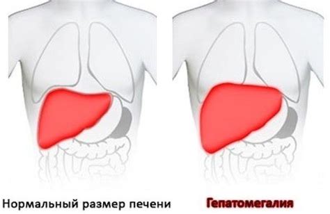 Гепатомегалия печени: симптомы, причины и лечение у взрослых мужчин