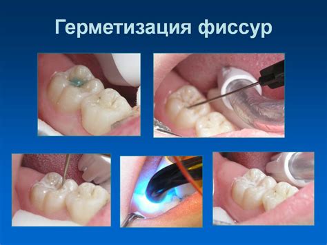 Герметизация фиссур у взрослых: зачем и как