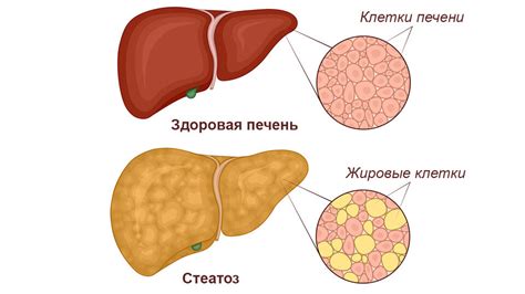 Гестоз печени - опасное заболевание