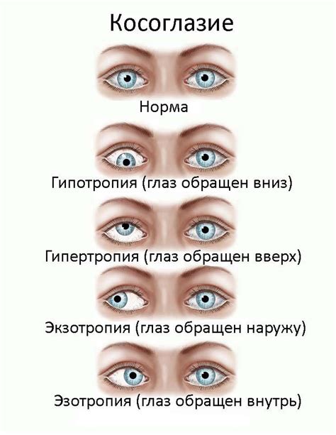 Гетерофория у детей: основные причины и методы лечения