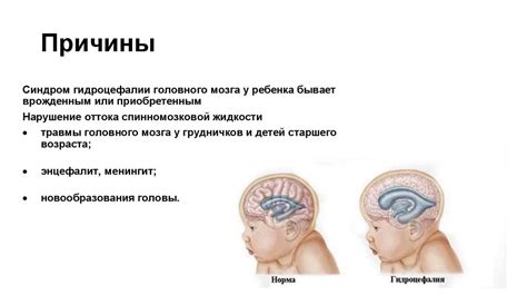 Гидроцефалия: что такое череп гидроцефальной формы?