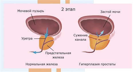 Гиперплазия предстательной железы