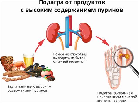 Гиперурисемия и подагра: основные симптомы и признаки