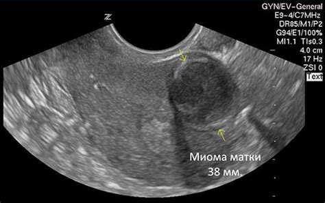 Гиподенсивное образование в матке: что это такое?