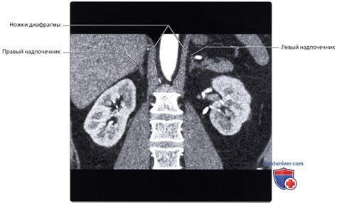 Гиподенсное образование левого надпочечника