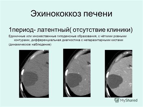 Гиподенсные очаговые образования в печени: