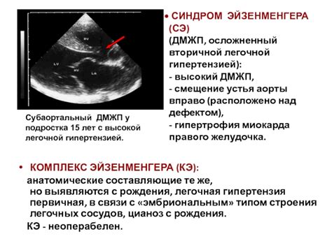 Гипокинез межжелудочковой перегородки сердца: симптомы и лечение