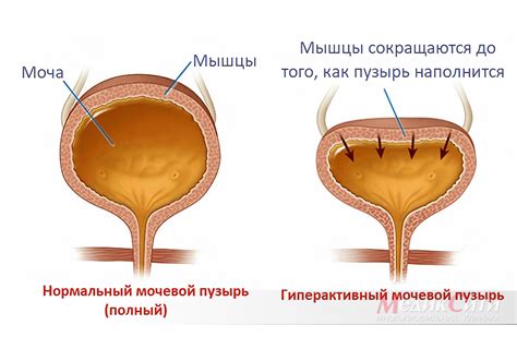 Гипоконтрактильный мочевой пузырь