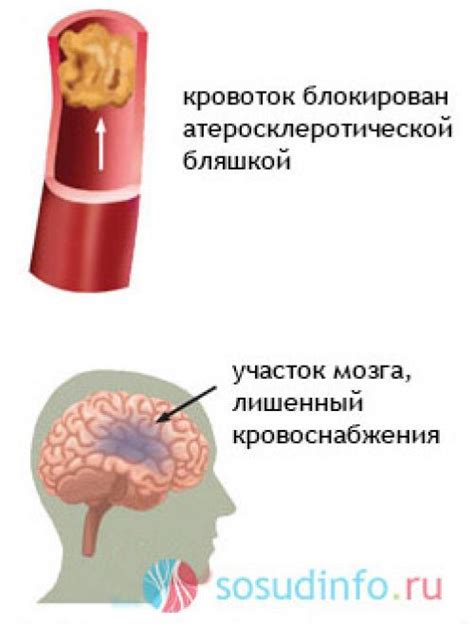 Гипоксический ишемический генез: механизм возникновения и причины