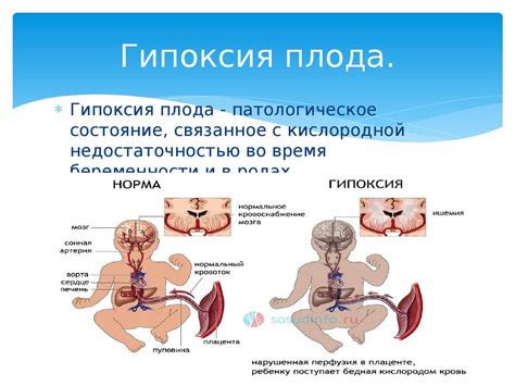 Гипоксия плода и ее последствия