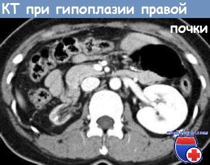 Гипоплазия левой почки у взрослых