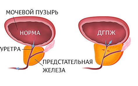 Гипоплазия предстательной железы у мужчин: основная информация