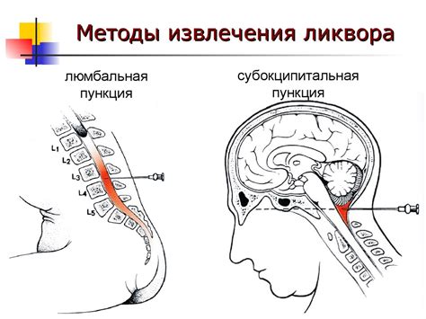 Гипорезорбция ликвора