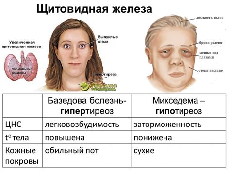 Гипотиреоз: болезнь щитовидной железы