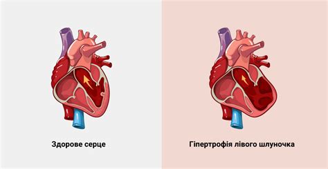 Гипотрофия левого желудочка сердца