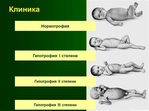 Гипотрофия 1 степени у детей: основная информация