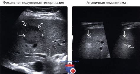 Гипоэхогенное неоднородное образование в печени