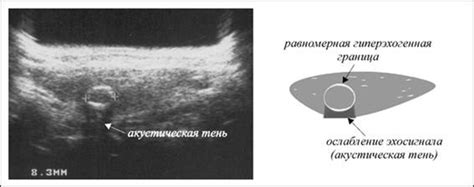 Гипоэхогенное образование: что это такое?
