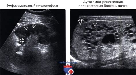 Гипоэхогенность в медицине